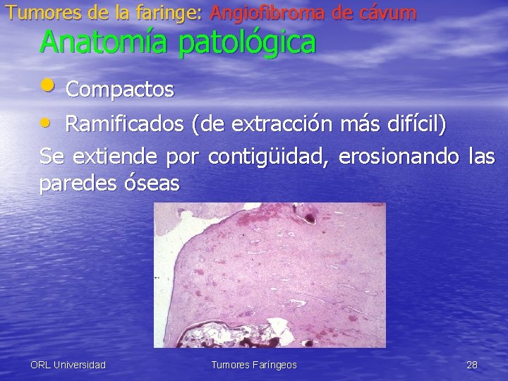 Tumores de la faringe: Angiofibroma de cávum Anatomía patológica • Compactos • Ramificados (de