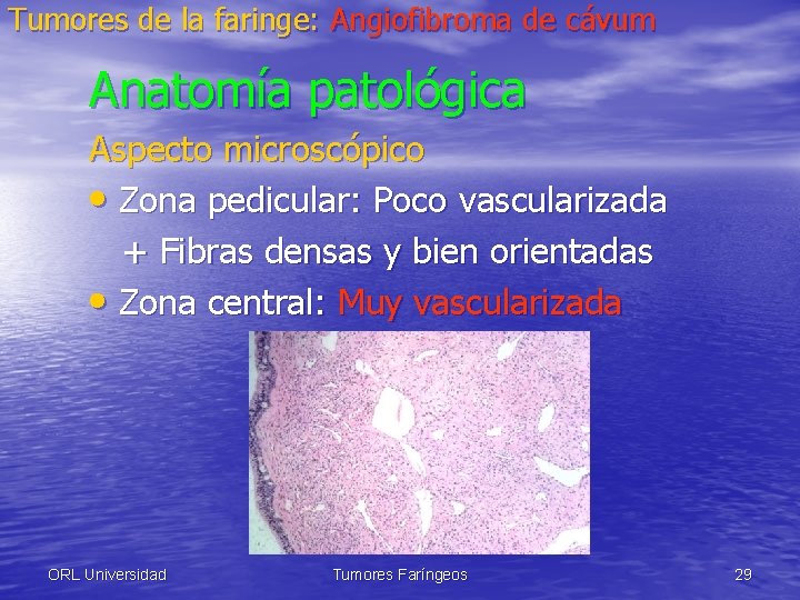 Tumores de la faringe: Angiofibroma de cávum Anatomía patológica Aspecto microscópico • Zona pedicular: