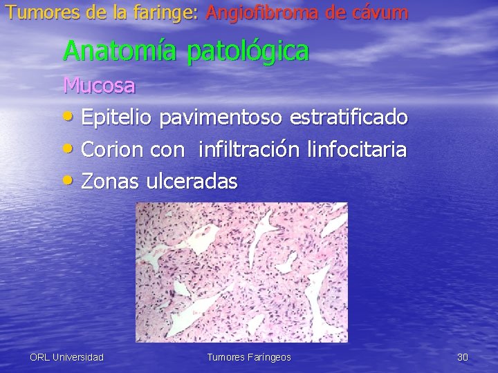 Tumores de la faringe: Angiofibroma de cávum Anatomía patológica Mucosa • Epitelio pavimentoso estratificado