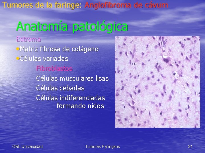 Tumores de la faringe: Angiofibroma de cávum Anatomía patológica Estroma • Matriz fibrosa de