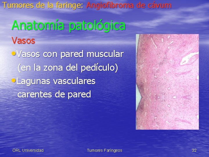 Tumores de la faringe: Angiofibroma de cávum Anatomía patológica Vasos • Vasos con pared