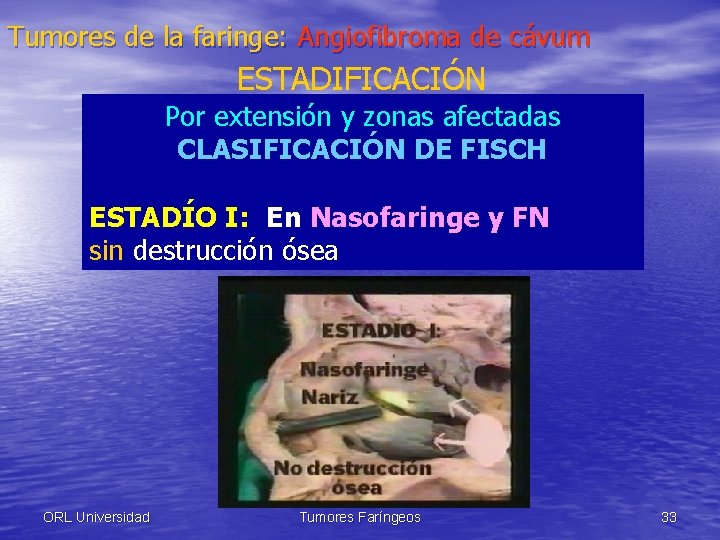 Tumores de la faringe: Angiofibroma de cávum ESTADIFICACIÓN Por extensión y zonas afectadas CLASIFICACIÓN