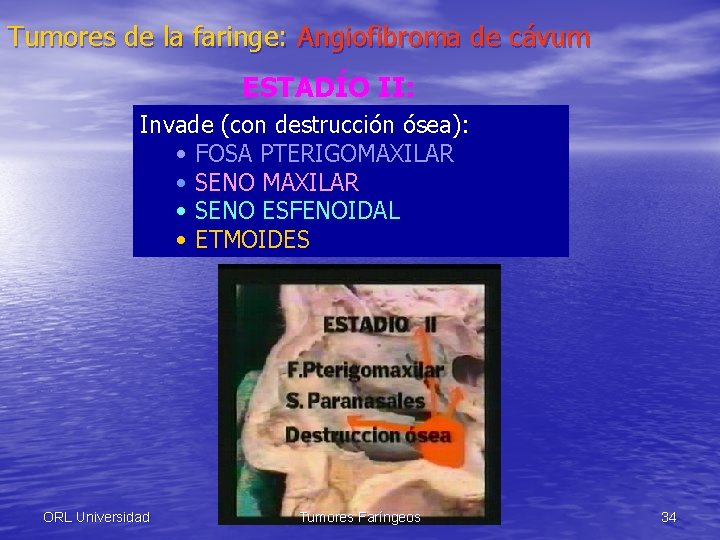 Tumores de la faringe: Angiofibroma de cávum ESTADÍO II: Invade (con destrucción ósea): •