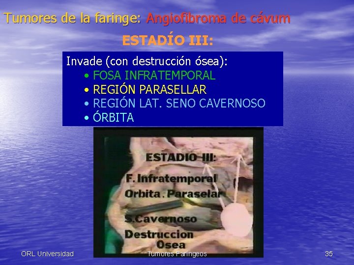 Tumores de la faringe: Angiofibroma de cávum ESTADÍO III: Invade (con destrucción ósea): •