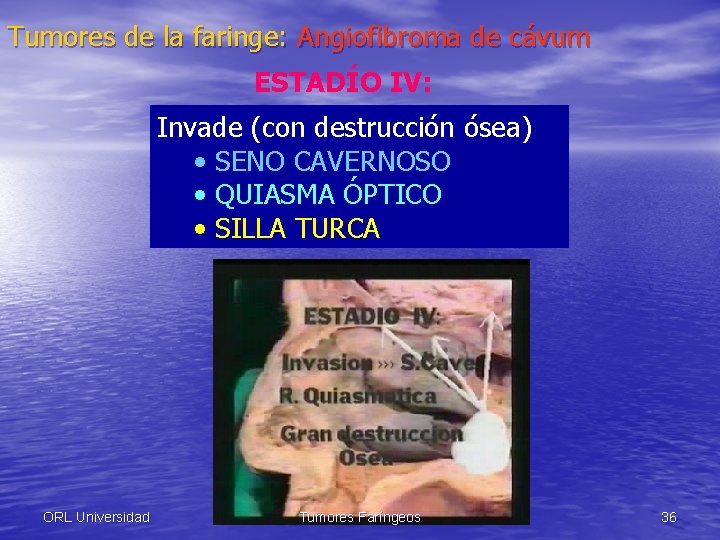 Tumores de la faringe: Angiofibroma de cávum ESTADÍO IV: Invade (con destrucción ósea) •