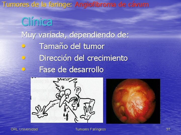 Tumores de la faringe: Angiofibroma de cávum Clínica Muy variada, dependiendo de: • Tamaño