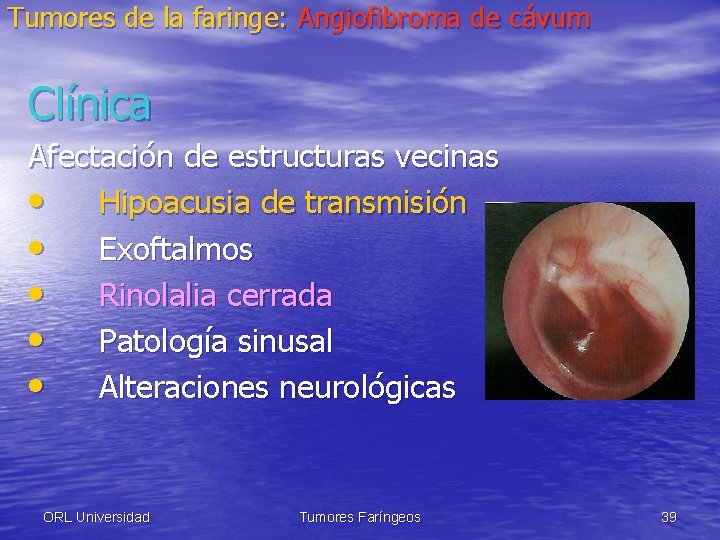 Tumores de la faringe: Angiofibroma de cávum Clínica Afectación de estructuras vecinas • Hipoacusia