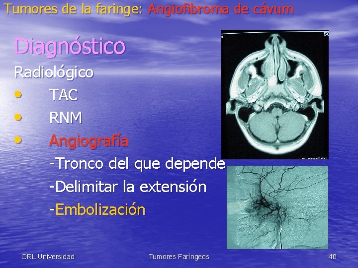Tumores de la faringe: Angiofibroma de cávum Diagnóstico Radiológico • TAC • RNM •