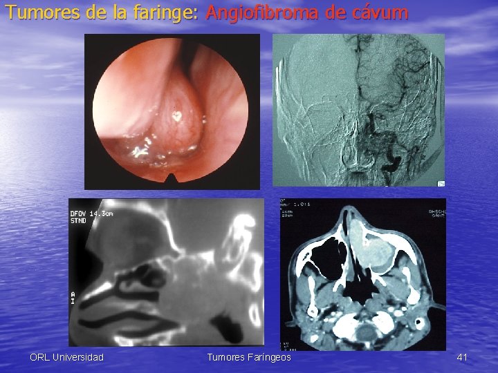 Tumores de la faringe: Angiofibroma de cávum ORL Universidad Tumores Faríngeos 41 