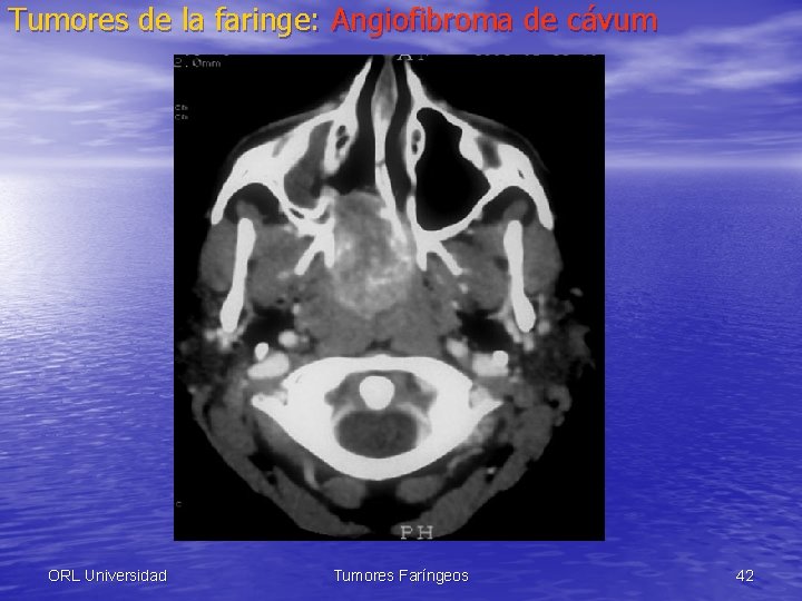 Tumores de la faringe: Angiofibroma de cávum ORL Universidad Tumores Faríngeos 42 