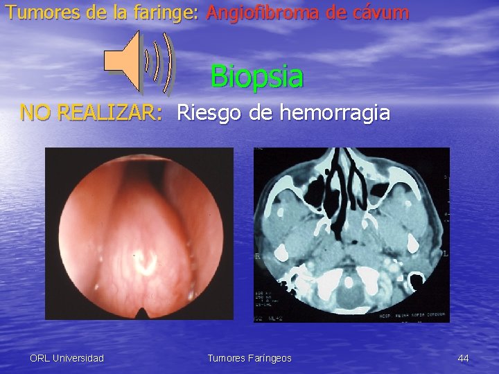 Tumores de la faringe: Angiofibroma de cávum Biopsia NO REALIZAR: Riesgo de hemorragia ORL