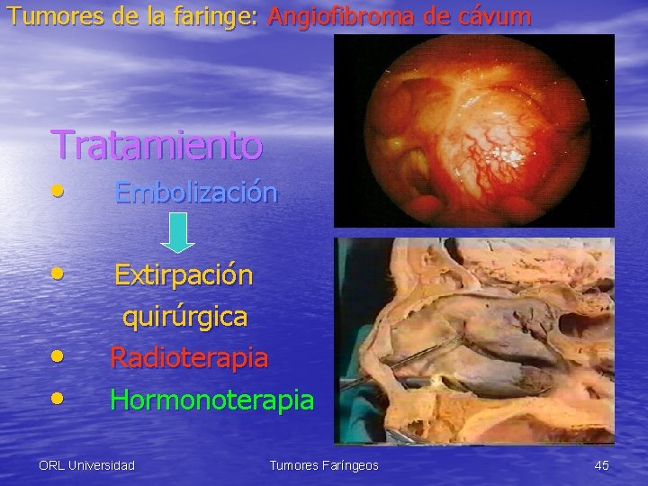 Tumores de la faringe: Angiofibroma de cávum Tratamiento • Embolización • Extirpación quirúrgica Radioterapia
