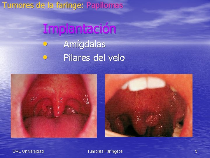 Tumores de la faringe: Papilomas Implantación • • ORL Universidad Amígdalas Pilares del velo