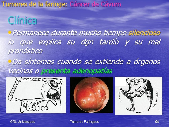 Tumores de la faringe: Cáncer de Cávum Clínica • Permanece durante mucho tiempo silencioso