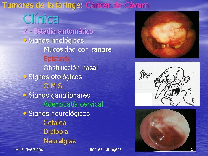 Tumores de la faringe: Cáncer de Cávum Clínica 2. - Estadio sintomático • Signos