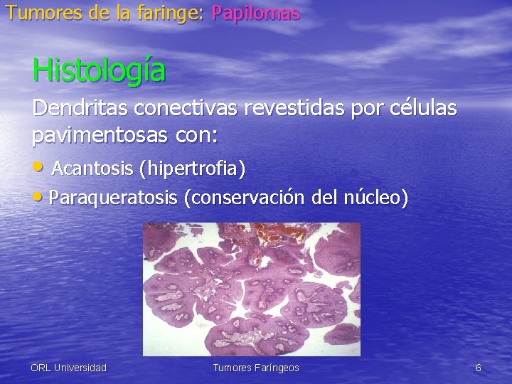 Tumores de la faringe: Papilomas Histología Dendritas conectivas revestidas por células pavimentosas con: •