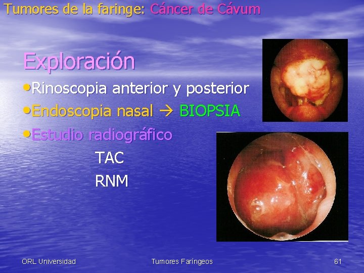 Tumores de la faringe: Cáncer de Cávum Exploración • Rinoscopia anterior y posterior •