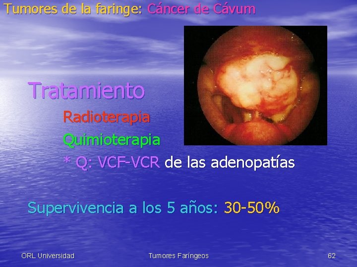 Tumores de la faringe: Cáncer de Cávum Tratamiento Radioterapia Quimioterapia * Q: VCF-VCR de