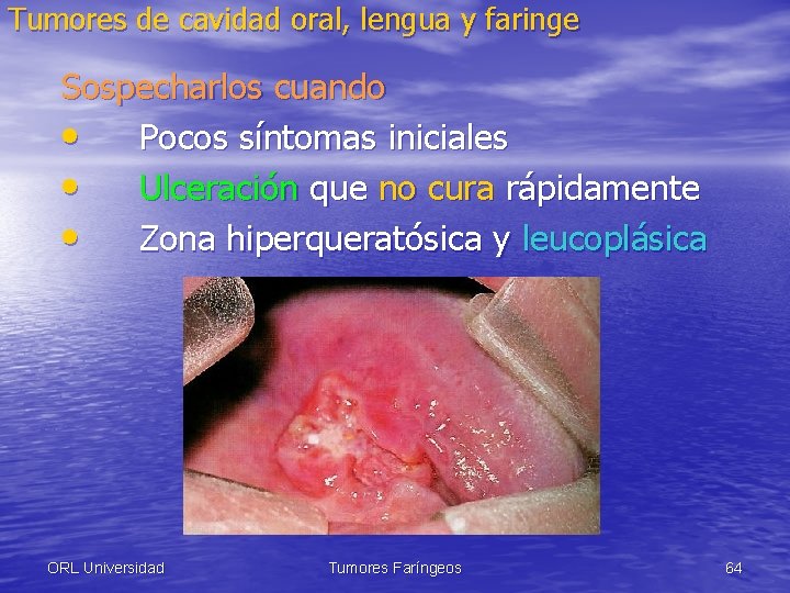 Tumores de cavidad oral, lengua y faringe Sospecharlos cuando • Pocos síntomas iniciales •