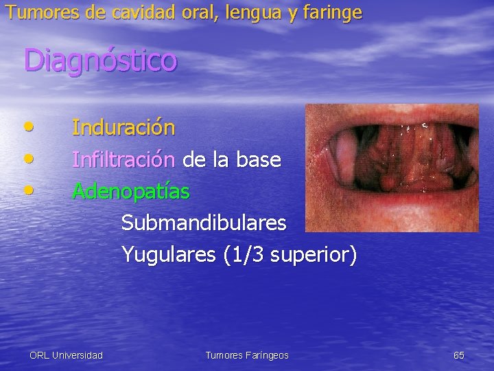 Tumores de cavidad oral, lengua y faringe Diagnóstico • • • Induración Infiltración de
