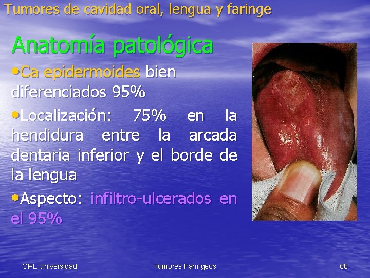 Tumores de cavidad oral, lengua y faringe Anatomía patológica • Ca epidermoides bien diferenciados