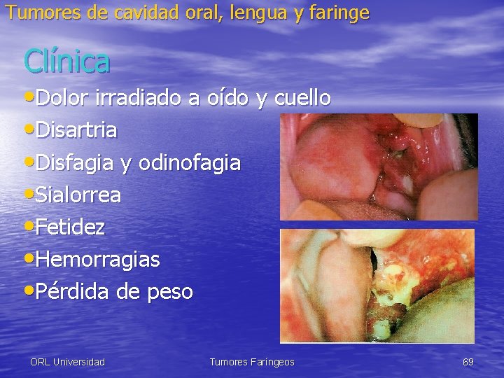 Tumores de cavidad oral, lengua y faringe Clínica • Dolor irradiado a oído y