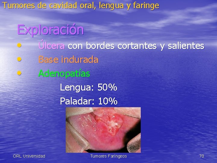 Tumores de cavidad oral, lengua y faringe Exploración • • • Úlcera con bordes