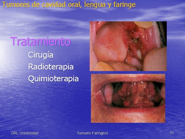 Tumores de cavidad oral, lengua y faringe Tratamiento Cirugía Radioterapia Quimioterapia ORL Universidad Tumores