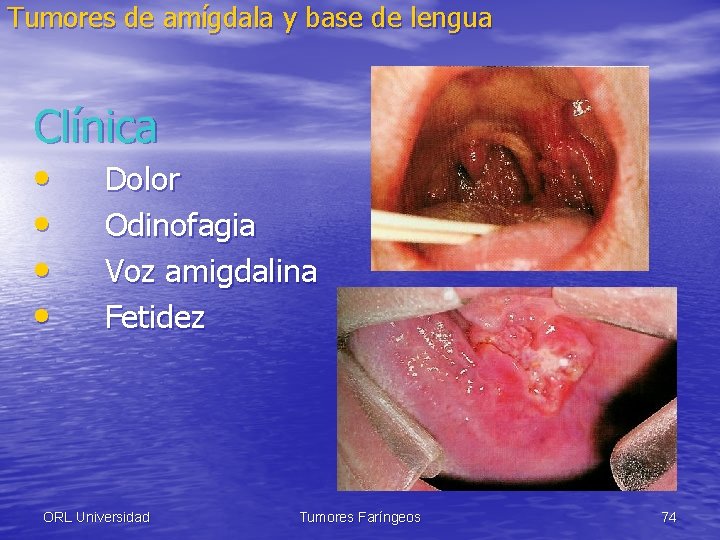 Tumores de amígdala y base de lengua Clínica • • Dolor Odinofagia Voz amigdalina