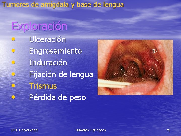 Tumores de amígdala y base de lengua Exploración • • • Ulceración Engrosamiento Induración