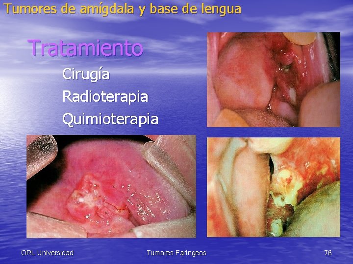 Tumores de amígdala y base de lengua Tratamiento Cirugía Radioterapia Quimioterapia ORL Universidad Tumores