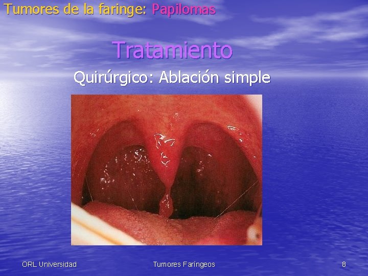 Tumores de la faringe: Papilomas Tratamiento Quirúrgico: Ablación simple ORL Universidad Tumores Faríngeos 8