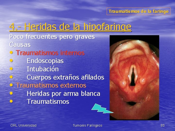 Traumatismos de la faringe 4. - Heridas de la hipofaringe Poco frecuentes pero graves