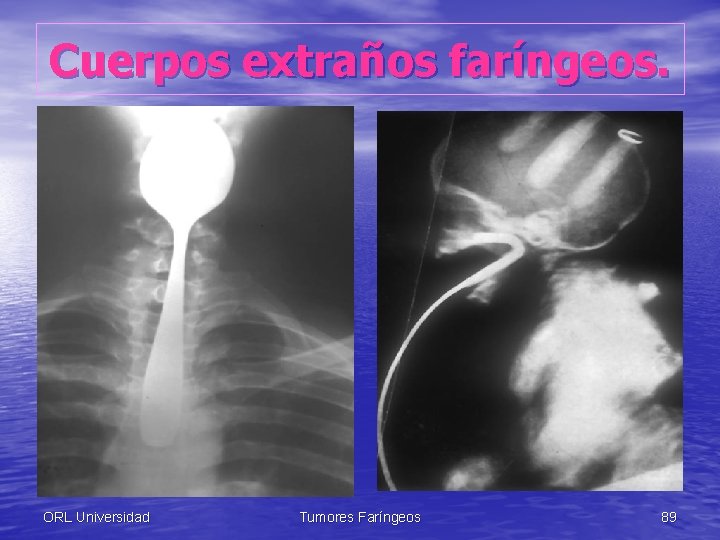 Cuerpos extraños faríngeos. ORL Universidad Tumores Faríngeos 89 