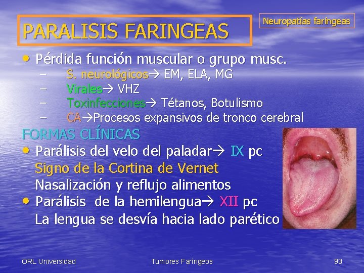 PARALISIS FARINGEAS Neuropatías faríngeas • Pérdida función muscular o grupo musc. – – S.