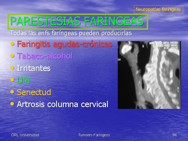 Neuropatías faríngeas PARESTESIAS FARÍNGEAS Todas las enfs faríngeas pueden producirlas • Faringitis agudas-crónicas •