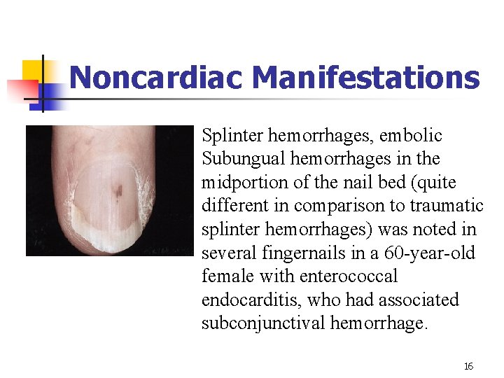 Noncardiac Manifestations Splinter hemorrhages, embolic Subungual hemorrhages in the midportion of the nail bed