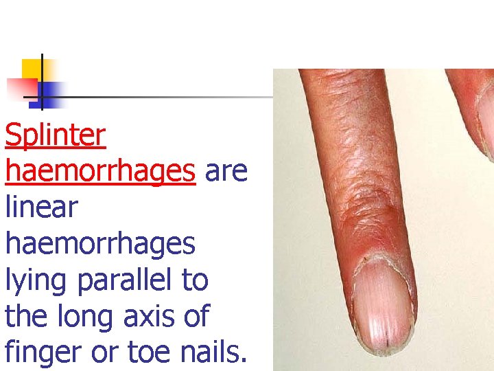 Splinter haemorrhages are linear haemorrhages lying parallel to the long axis of finger or