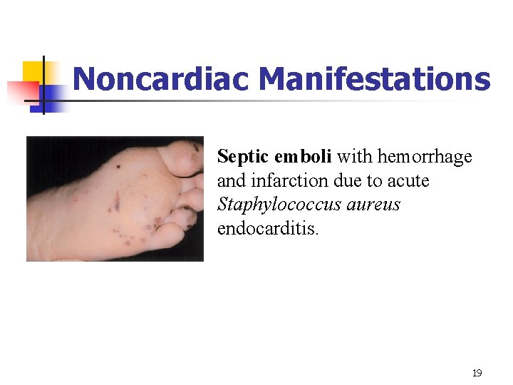 Noncardiac Manifestations Septic emboli with hemorrhage and infarction due to acute Staphylococcus aureus endocarditis.