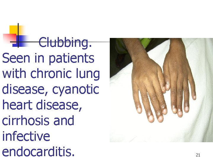 Clubbing. Seen in patients with chronic lung disease, cyanotic heart disease, cirrhosis and infective
