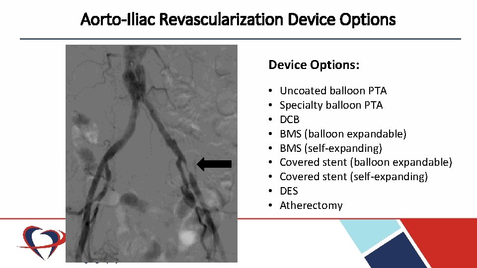 Aorto-Iliac Revascularization Device Options: • • • Uncoated balloon PTA Specialty balloon PTA DCB