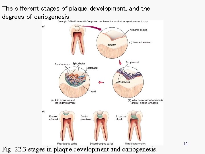 The different stages of plaque development, and the degrees of cariogenesis. Fig. 22. 3