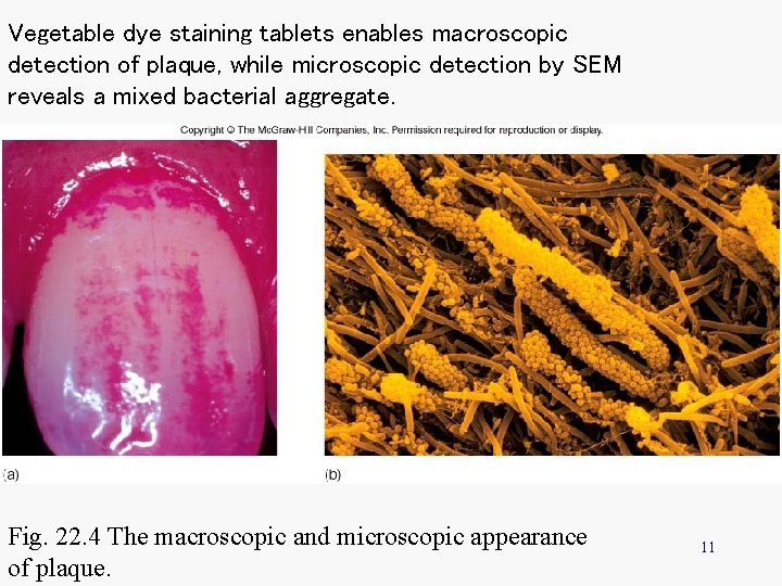 Vegetable dye staining tablets enables macroscopic detection of plaque, while microscopic detection by SEM