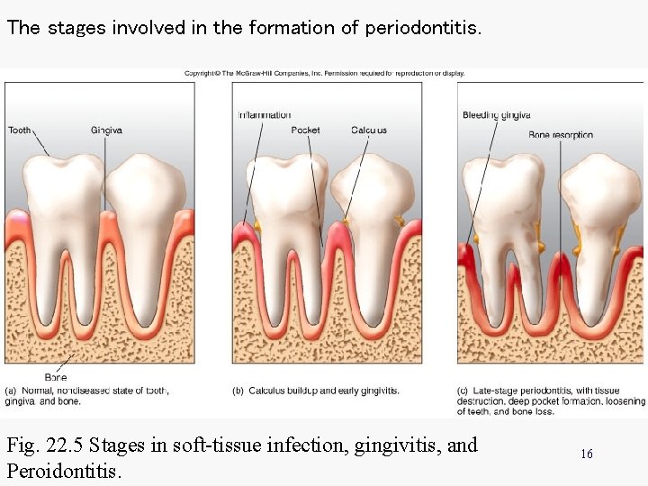 The stages involved in the formation of periodontitis. Fig. 22. 5 Stages in soft-tissue