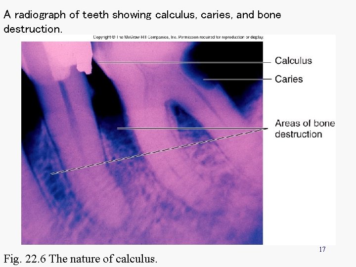 A radiograph of teeth showing calculus, caries, and bone destruction. Fig. 22. 6 The