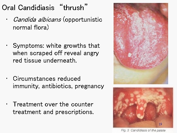 Oral Candidiasis “thrush” • Candida albicans (opportunistic normal flora) • Symptoms: white growths that