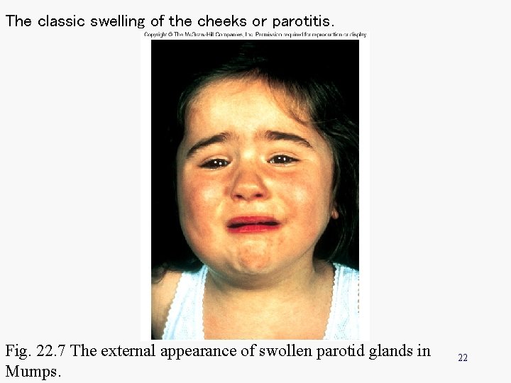 The classic swelling of the cheeks or parotitis. Fig. 22. 7 The external appearance