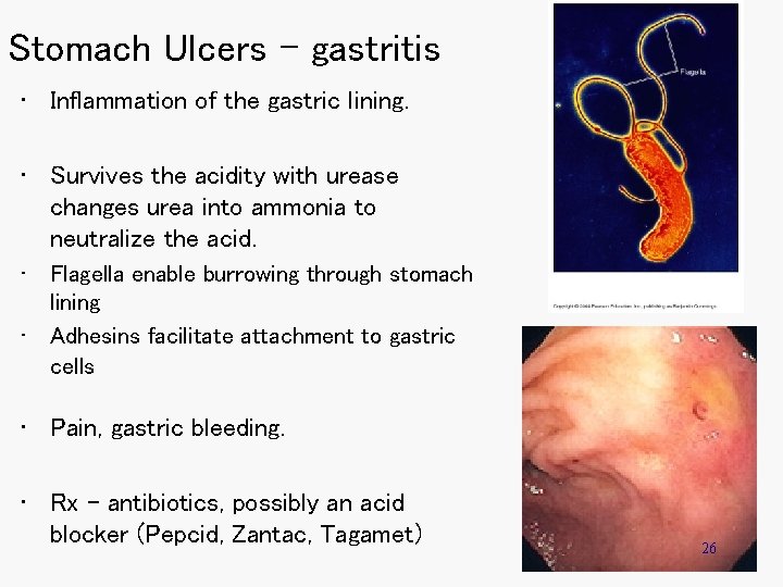 Stomach Ulcers - gastritis • Inflammation of the gastric lining. • Survives the acidity