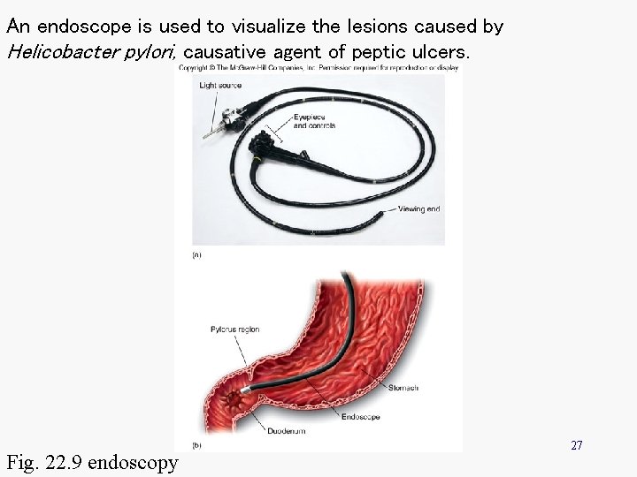 An endoscope is used to visualize the lesions caused by Helicobacter pylori, causative agent