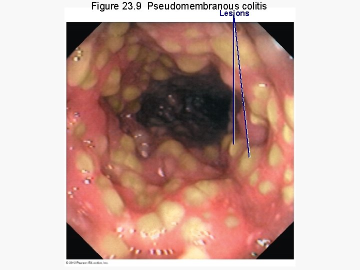 Figure 23. 9 Pseudomembranous colitis Lesions 